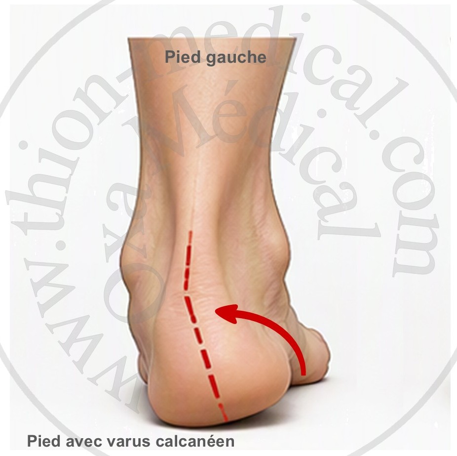 Photo de pied varus